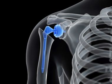 What You Need to Know About Shoulder Reconstruction Surgery
